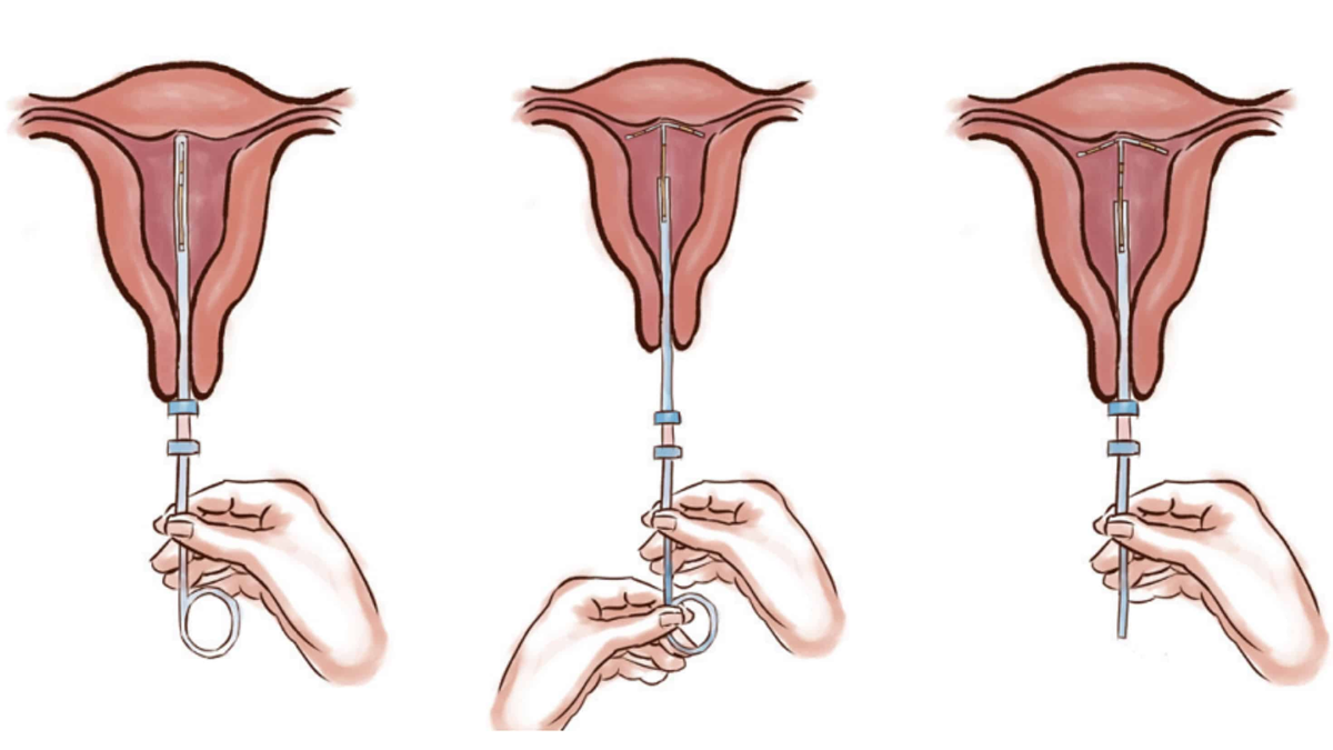 Inserção de DIU Hormonal e Não Hormonal